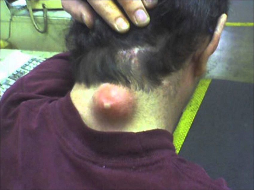 zit.jpg